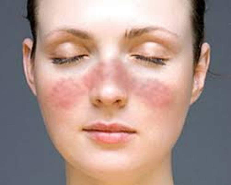 &quot;Día Mundial del Lupus&quot;: El silencioso ataque de nuestro cuerpo